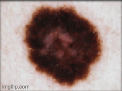 Skin cancer deep learning